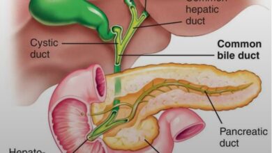 श्री महंत  इन्दिरेश अस्पताल में हुई   ‘यूनाइटेड बाय यूनीक‘ थीम को साकार करती पित्ताशय कैंसर की अति-दुर्लभ सर्जरी, उत्तराखण्ड में इस तरह की कैंसर सर्जरी का यह पहला मामला